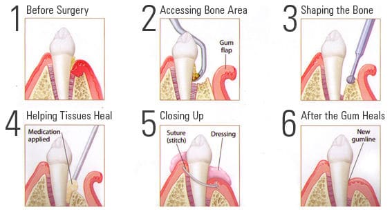 Periodontal Surgery In Westerville And Lancaster Oh Dr Benjamin Metz